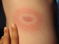 1426433446_erythema.jpg